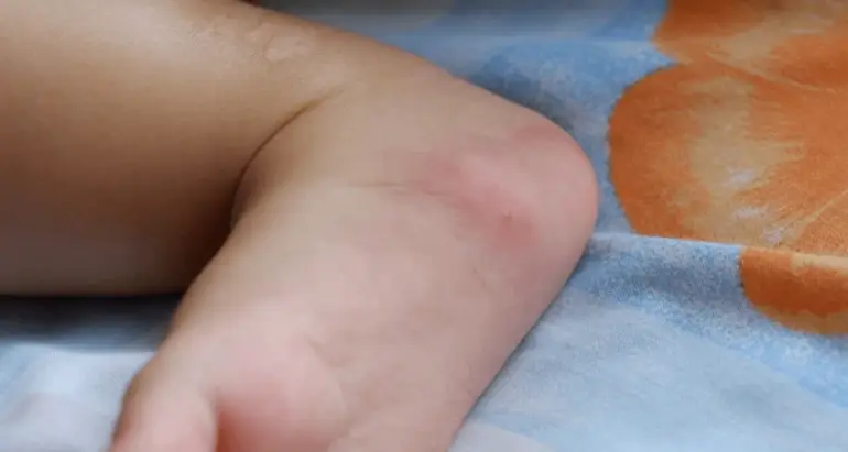 Why Pest Problems Pose Higher Risks for Children and Seniors